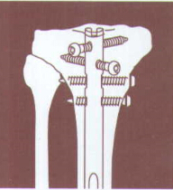 Zimmer SURGIGAL TEGHNIQUE FOR M/DN TIBIAL NAIL FIXATION