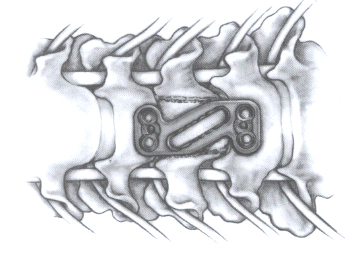 美敦力ORION颈椎前路固定系统