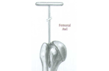 ZIMMER SURGIGAL TEGHNIQUE FOR M/DN HUMERAL NAIL FIXATION